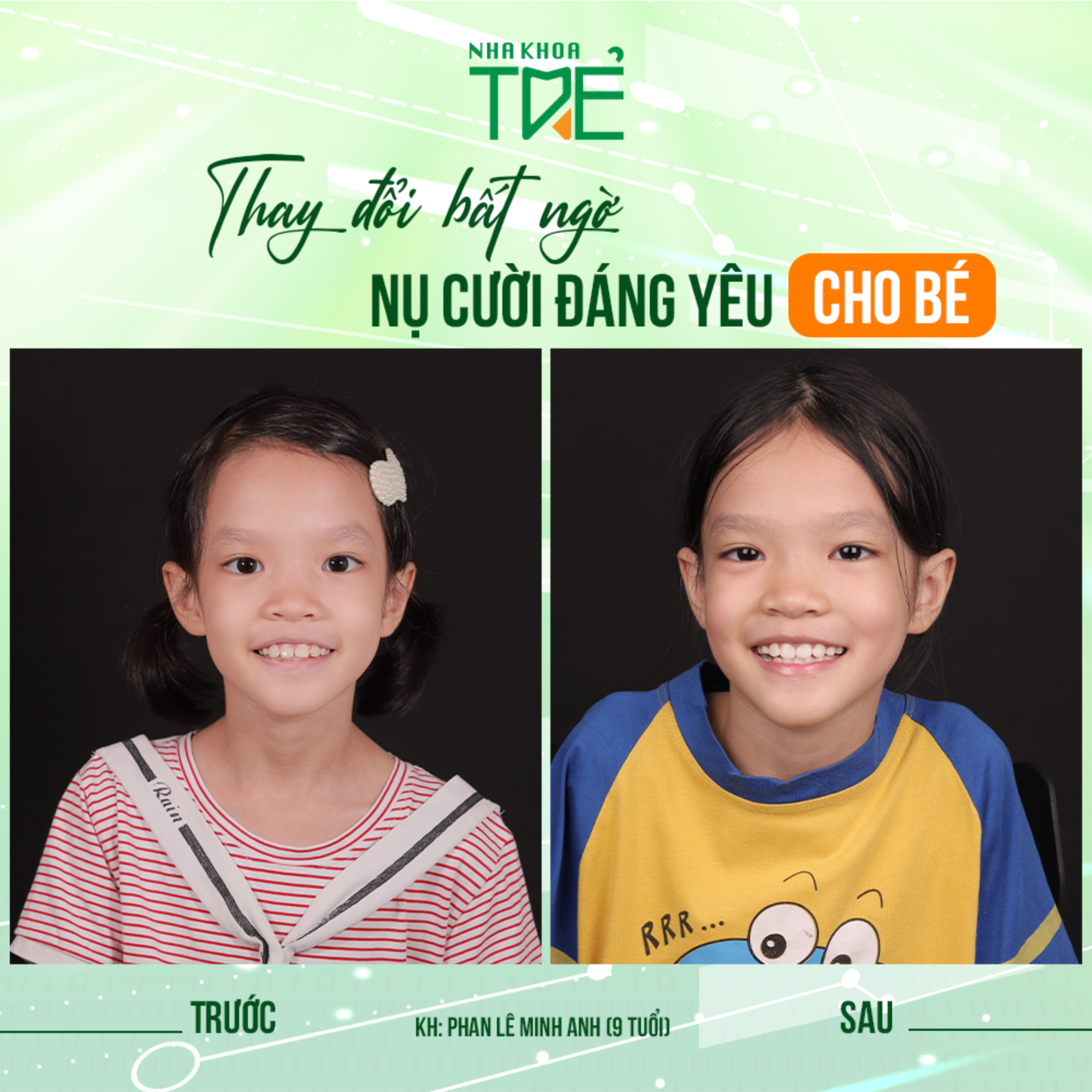 Kết thúc liệu trình, lắp hàm duy trì