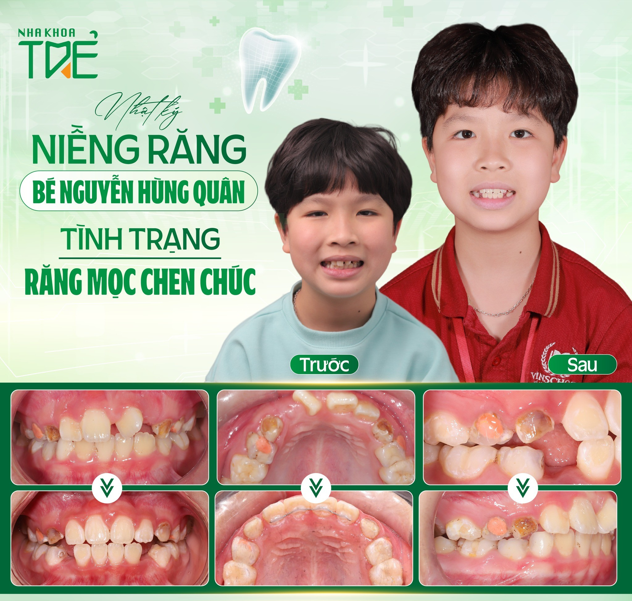 Khắc phục sai lệch hiệu quả hơn khi còn nhỏ