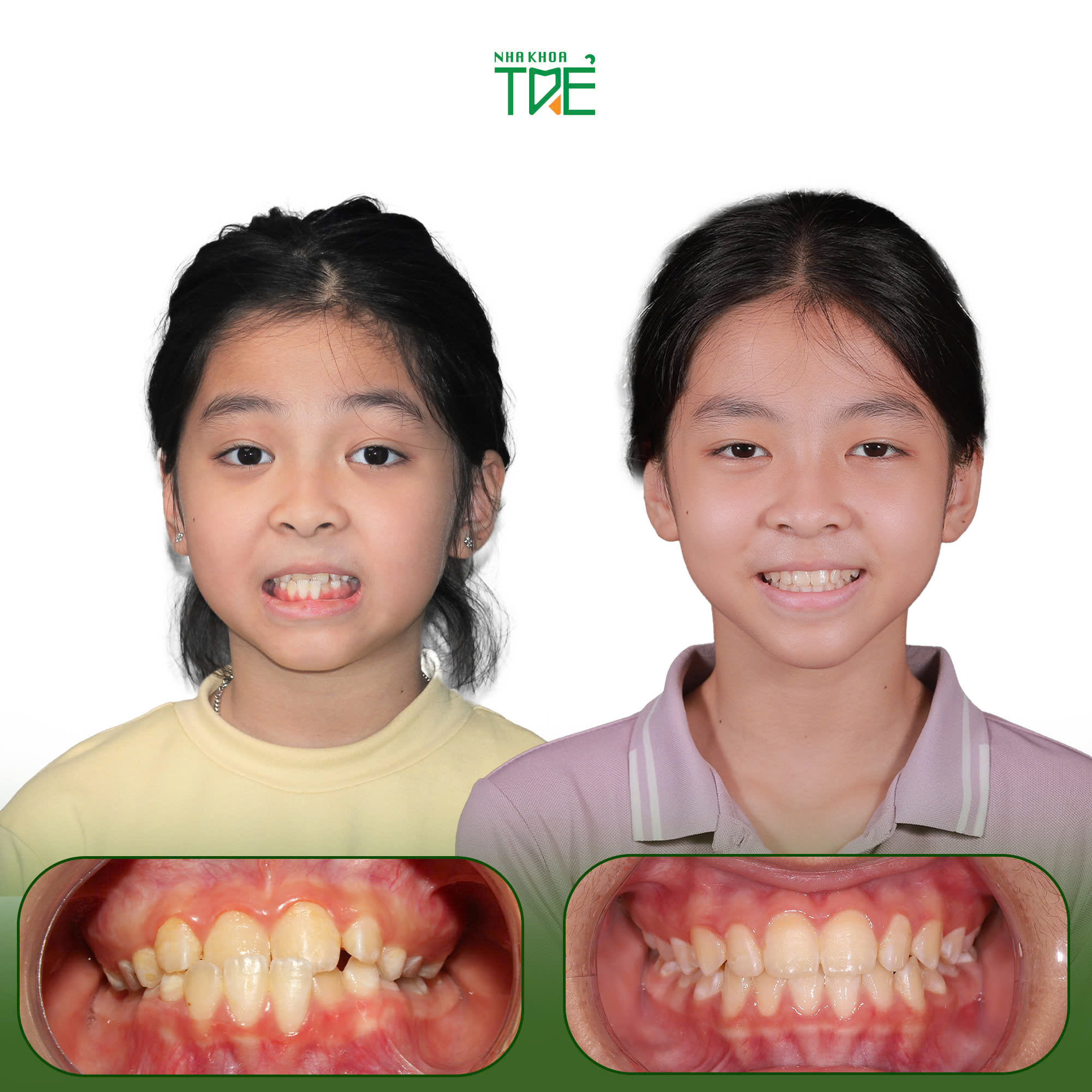 Kết quả chỉnh nha trẻ em trước và sau 1