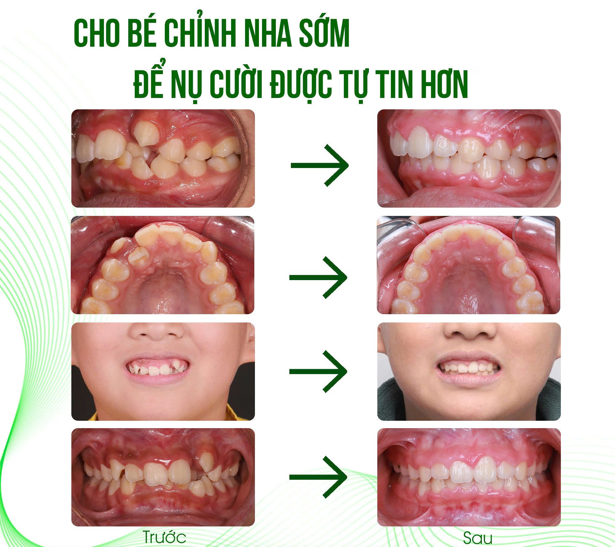 Kết quả trước và sau khi chỉnh nha sớm cho bé